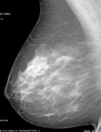 Scattered-Density Breast Tissue