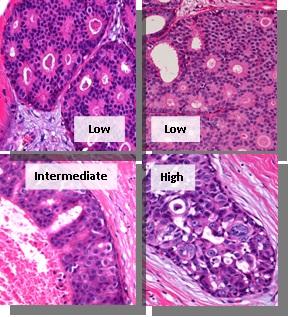 Ductal Carcinoma In Situ