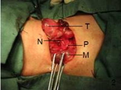 Recurrent Laryngeal Nerve