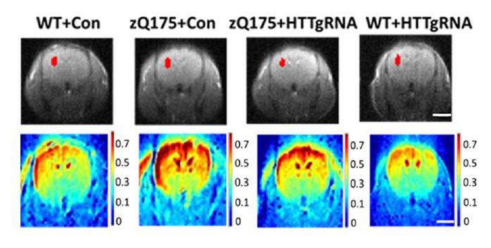 Cerebral blood volume map