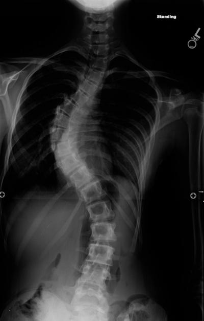 Severe Scoliosis