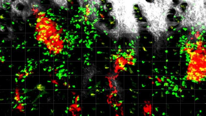 CD4+ T cells attacking melanoma cells in the skin.