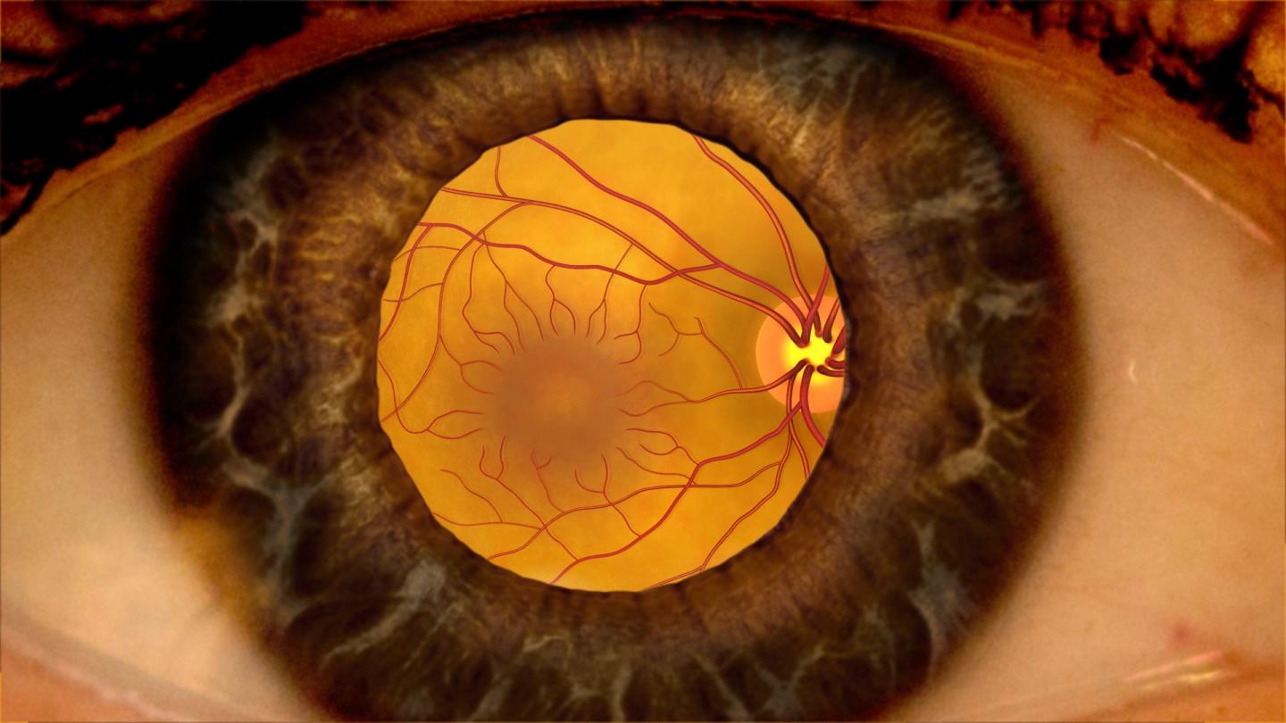 Diabetic Retinopathy