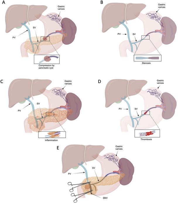 Mechanisms of development of splenic vein hypertension