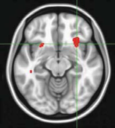 Insula Activity Predicts Treatment Response