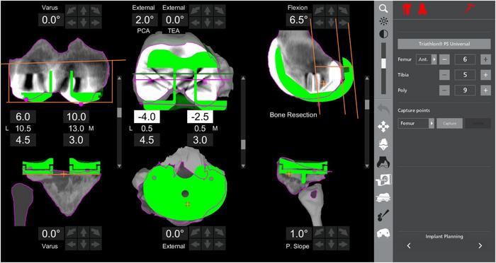 Comparison of Robotic Revision and Primary Implants