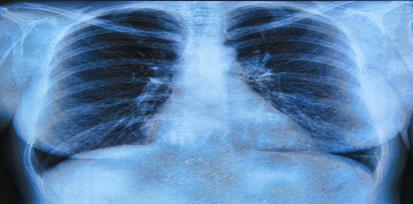 Cystic Fibrosis Lung