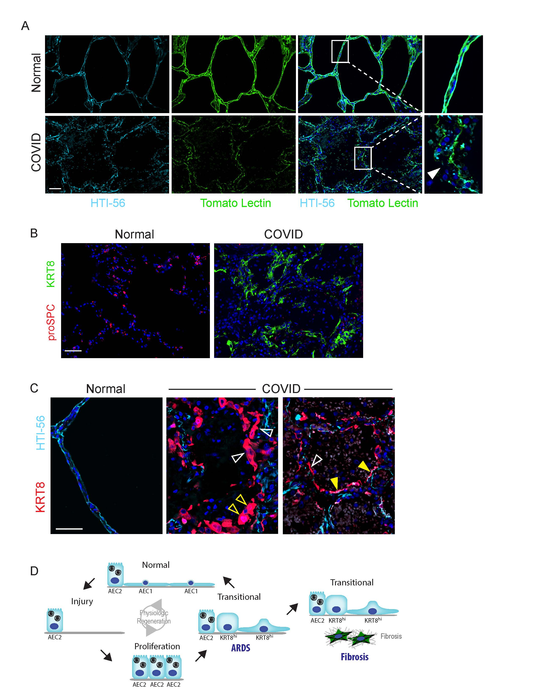 Disruption in lung cell repair may underlie acute respiratory distress syndrome in COVID-19 and other respiratory diseases