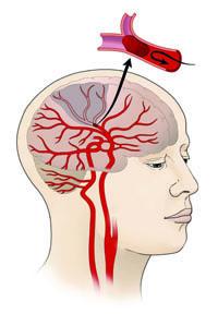 Illustration of Ischemic Stroke