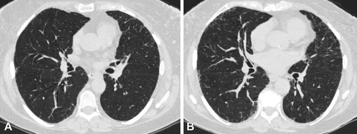 Axial chest CT scans
