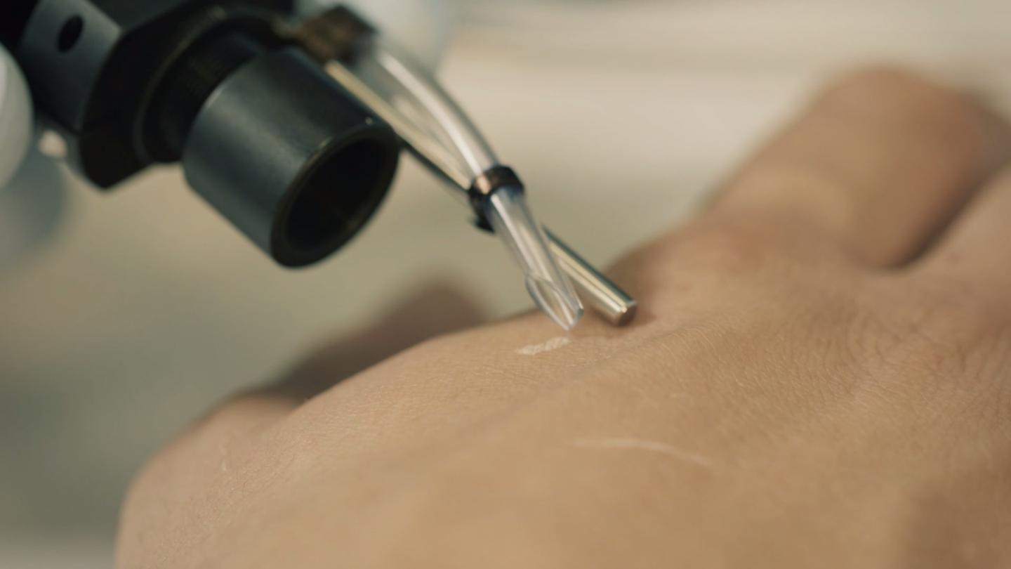 SpiderMass Device for Painless Mass Spectrometry of Living Tissue