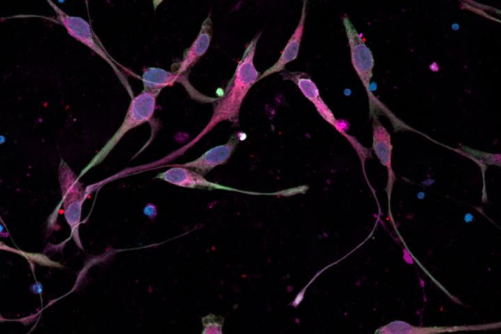 Childhood Brain Cancer Cells Grown from Patient Cells in the Laboratory