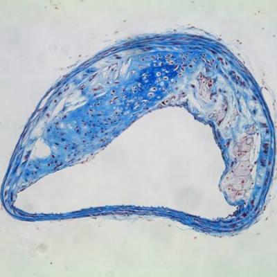 Intact Arterial Plaque
