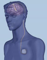 Ohio State Implants First Brain Pacemaker To Treat Alzheimer's