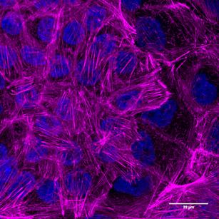 Cytoskeleton Fibers in Benign Breast Tumor Cells