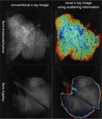 New X-ray Imaging Technology Enables Improved Diagnosis of Pulmonary Emphysema