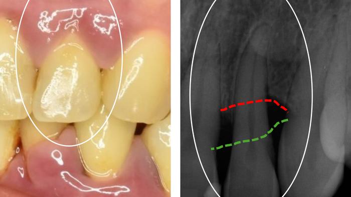 Picture montage periodontitis