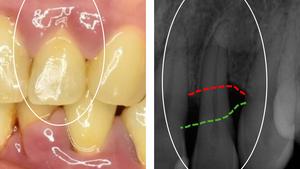 Picture montage periodontitis