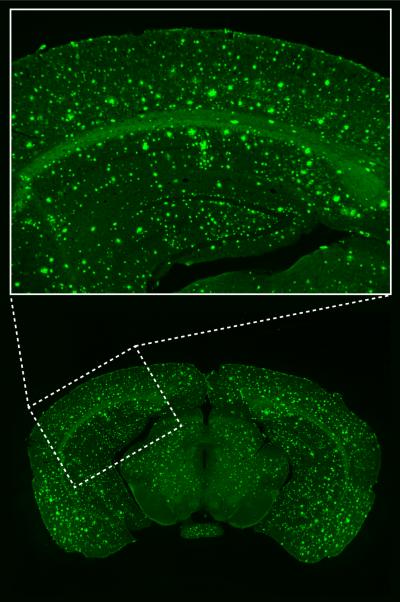 Beta-Amyloid Plaques in the Visual Cortex