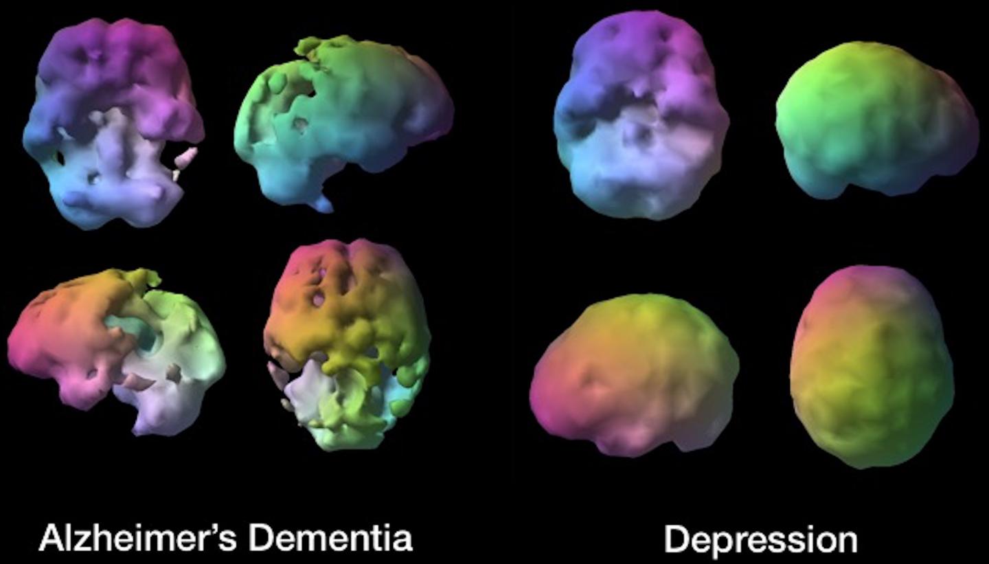 brain scan depression