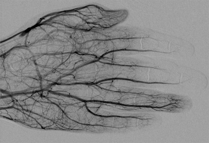 54-Year-Old Man with Third Degree Frostbite Injury of Left Hand that Was Managed with Catheter-Direc