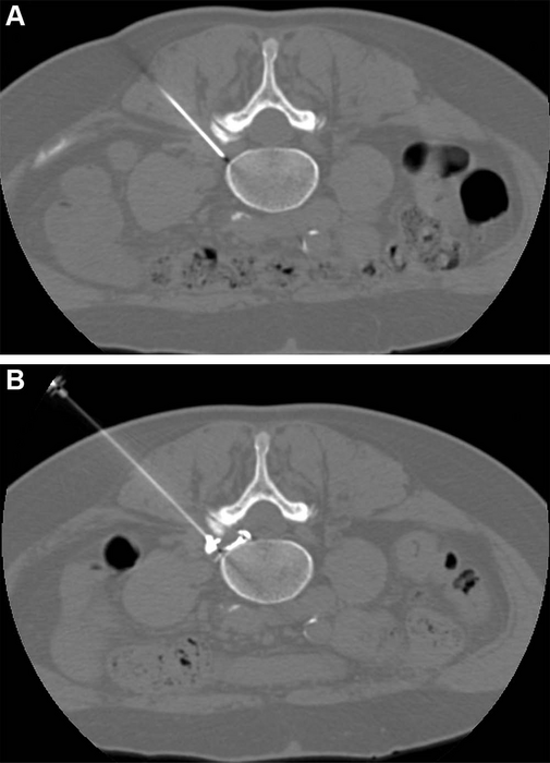 Pulsed Radiofrequency with Steroid Injection Brings Sciatica Relief