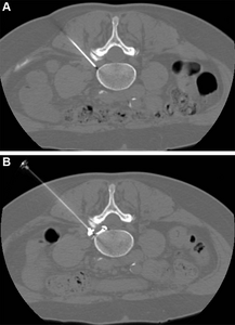 Pulsed Radiofrequency with Steroid Injection Brings Sciatica Relief