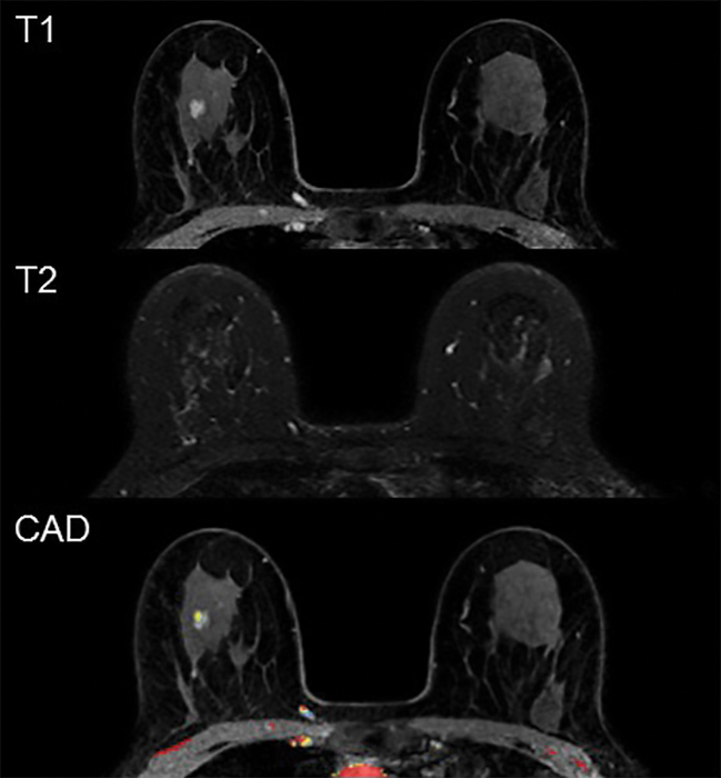 Prediction Models May Reduce False-Positives in MRI Breast Cancer Screening