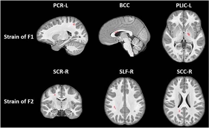 Youth Football Changes Nerve Fibers in Brain