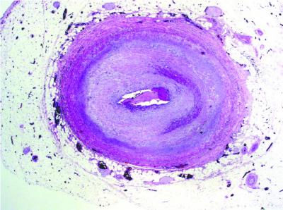 Heart-transplant Blood Vessel