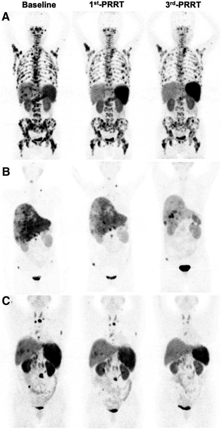 Representative images of partial remission.