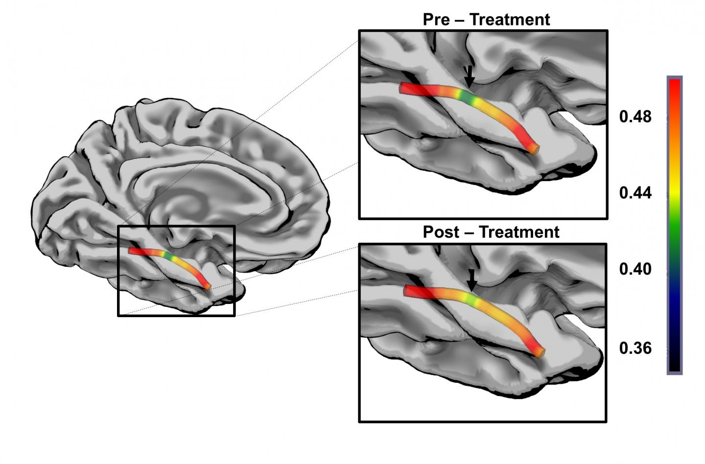 Pre-and Post-Treatment Mean Kurtosis Values along the Core ILF from a Represenative Participant