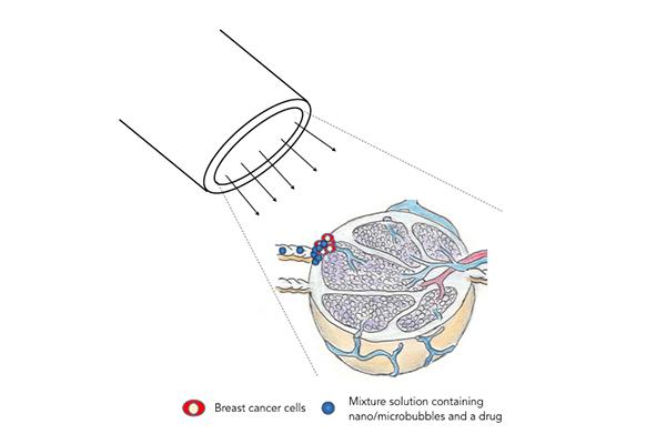 Attacking Metastatic Breast Cancer with Sound