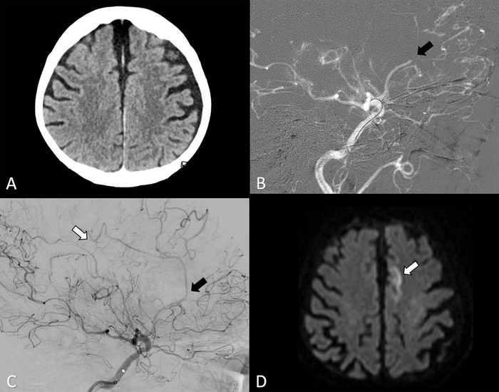 Thrombectomy Comparable to Medical Management for Strokes