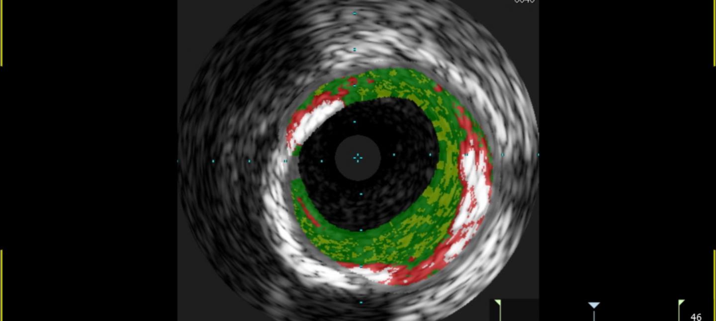Tick-borne Meat Sensitivity Linked to Heart Disease 3