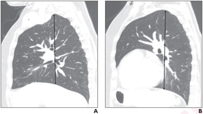 62-Year-Old Woman Who Underwent Hysterectomy for Uterine Cancer