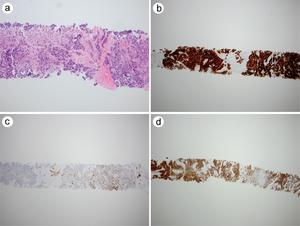 An index case of CAIX expression in epithelioid mesothelioma