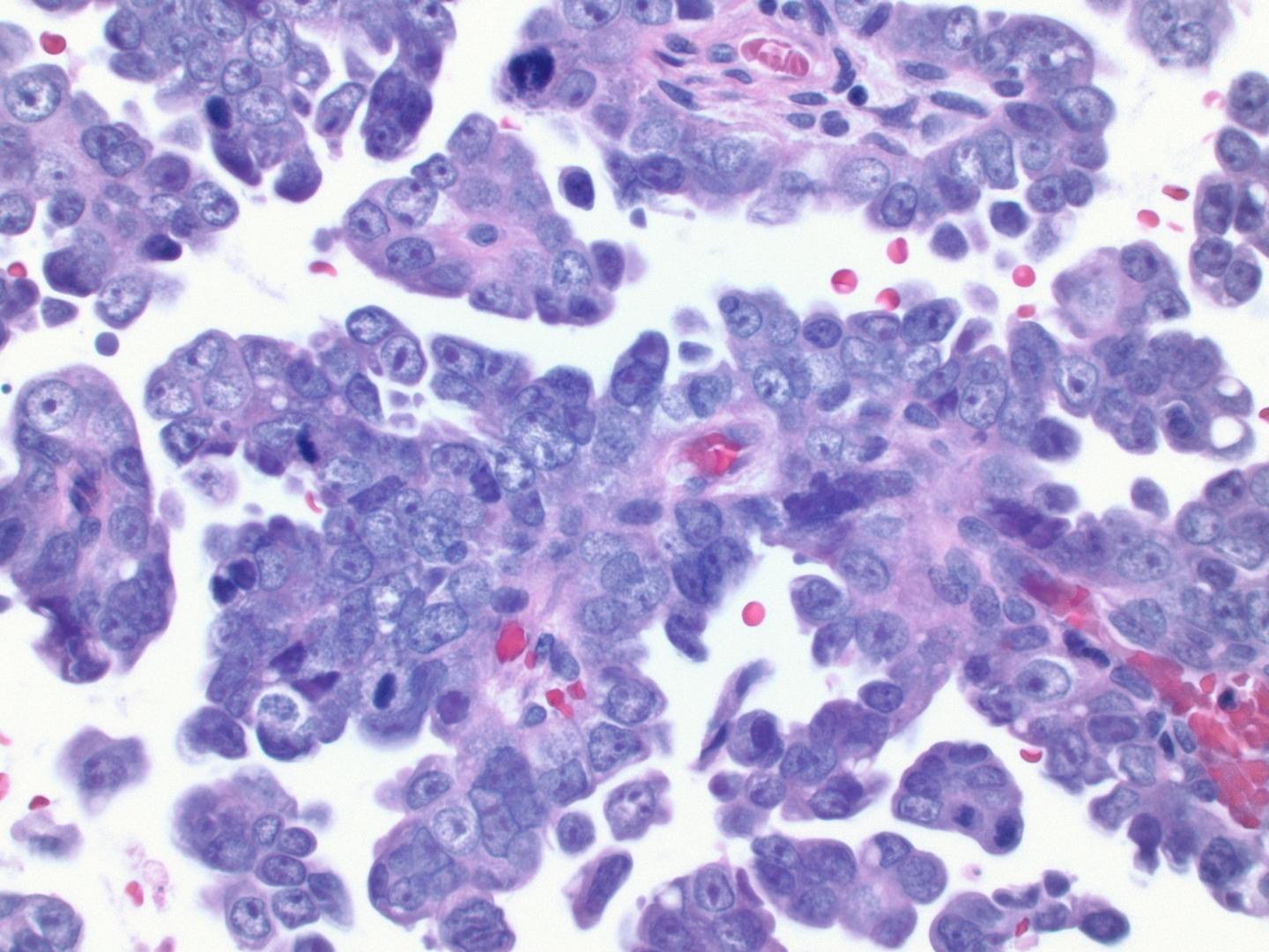 Histology Slide of Serous Endometrial Cancer