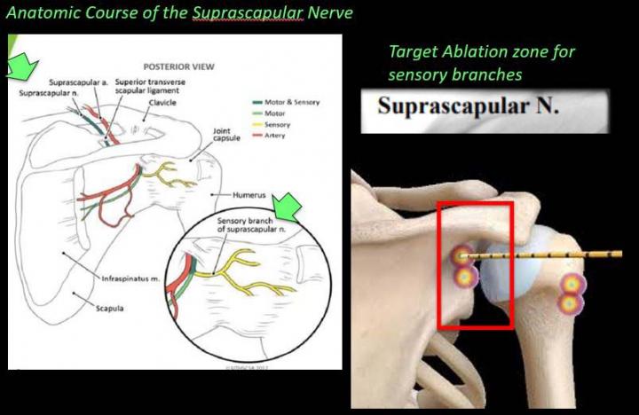 Novel Technique 'Stuns' Arthritis Pain in Shoulder and Hip