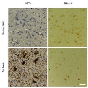 TRIM11 in Alzheimer's Disease Brain vs. normal brain