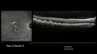 Calcified Eye Spots Linked to Progression of | EurekAlert!