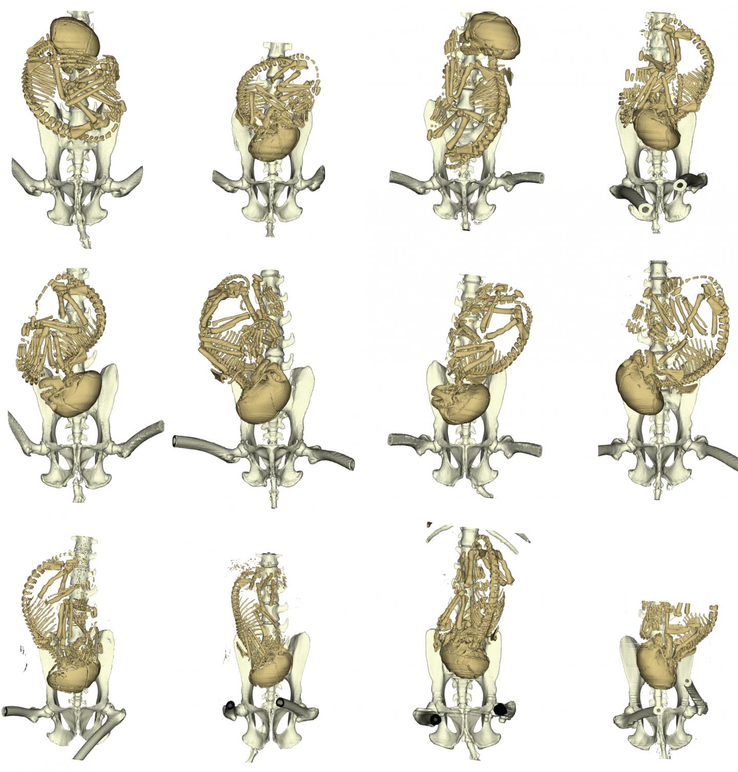 Maternal pelvis and fetal skull covariation