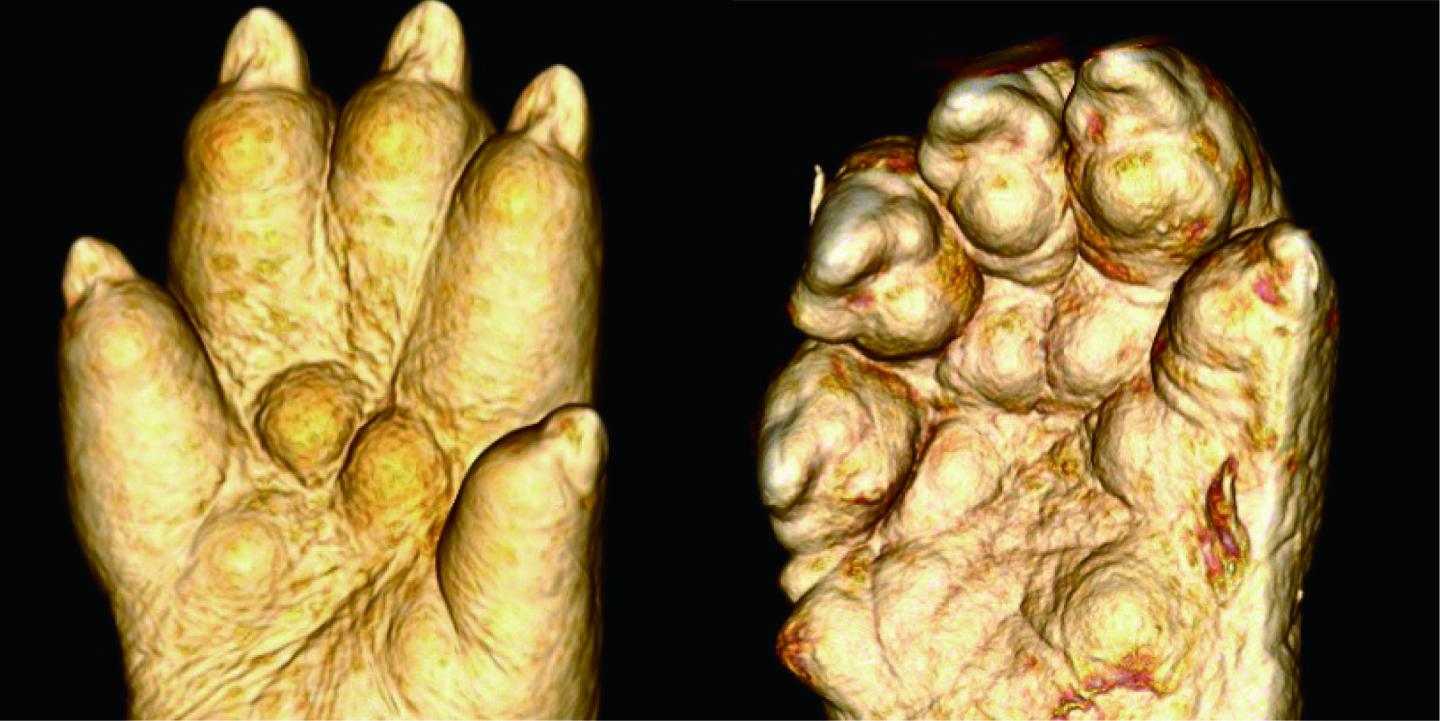 'Hammer Toe' Appeared in a Mutant Mouse Line