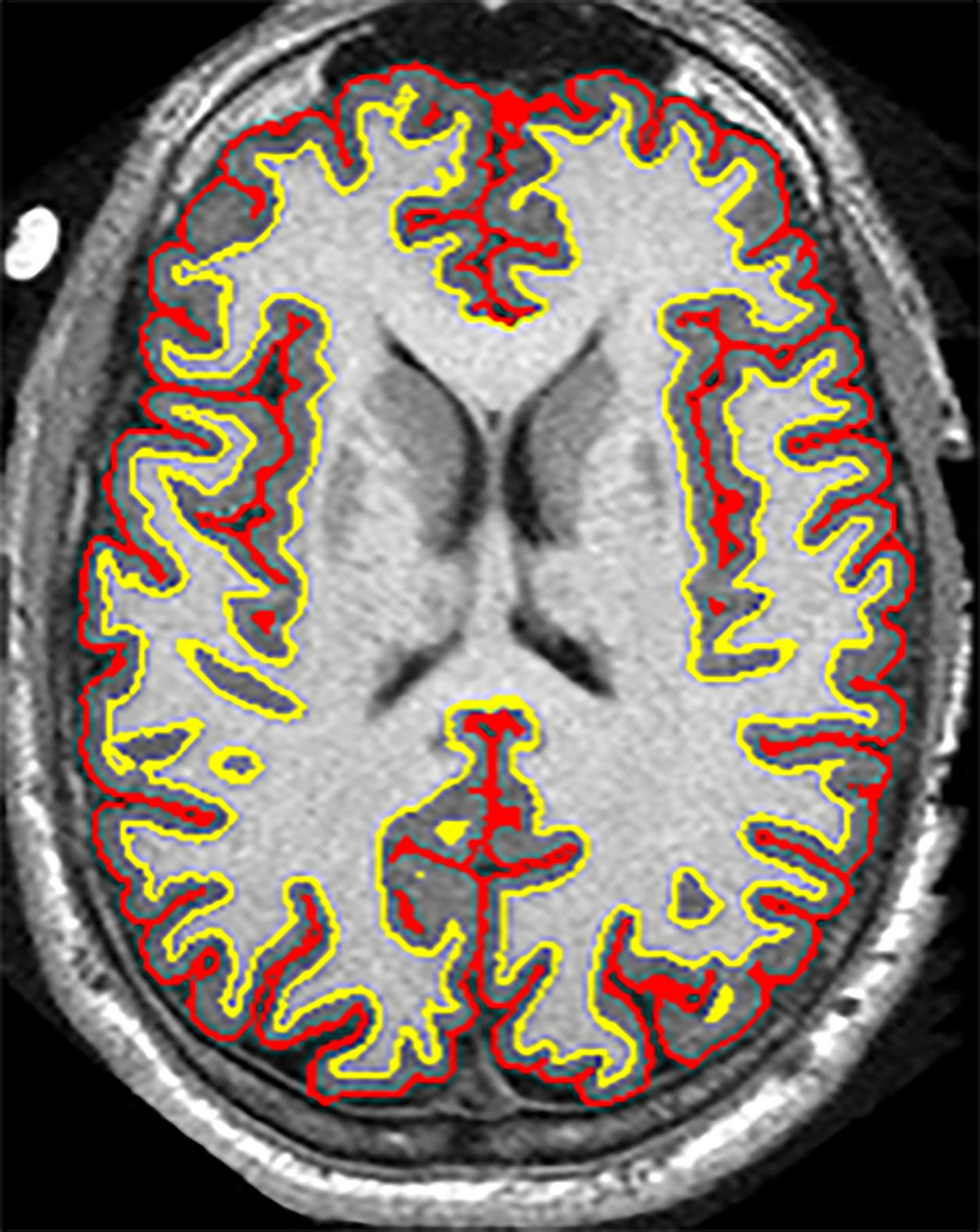 Slowing MS Brain Shrinkage