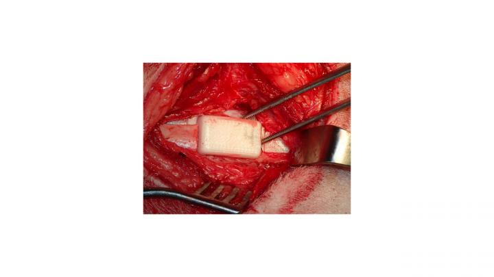 Bioreactors Filled With Either Autologous Bone Or Synthetic Graft.
