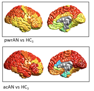 Brain Shrinkage in Anorexia