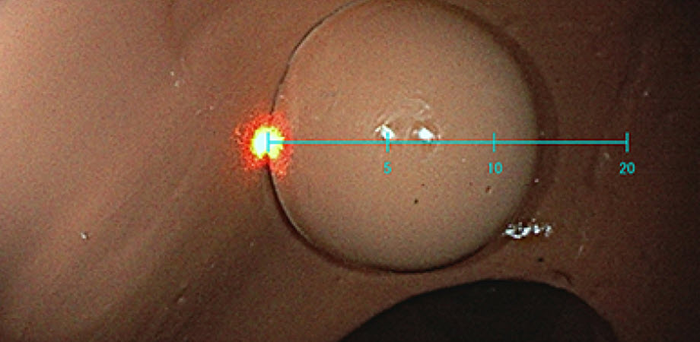 Estimating the size of a silicon polyp in a colon model.