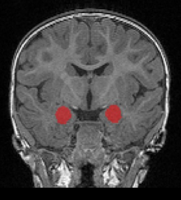 MRI_amygdala