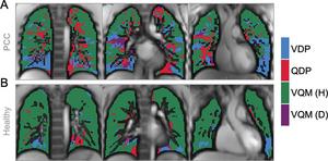 Images show exemplary coronal sections of phase-resolved functional lung MRI defect maps in a pediatric participant with post–COVID-19 condition and cardiopulmonary symptoms and a healthy control patient.