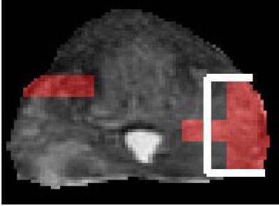MRI Assessment of Prostate Cancer Severity